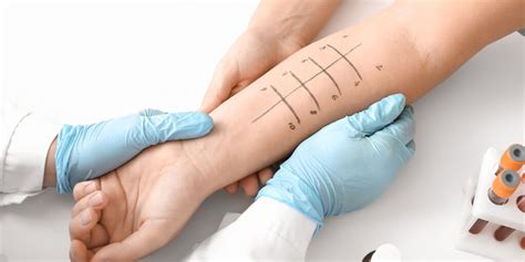 scratch test allergy cost|affordable allergy testing near me.